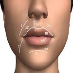 Surgical lip lift